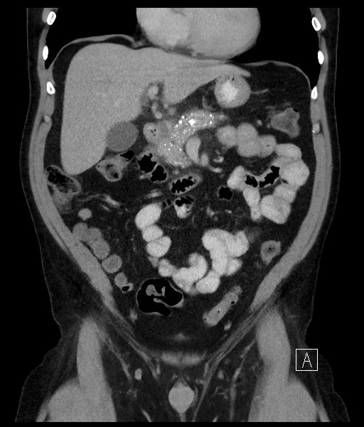 Acute-on-chronic pancreatitis (Radiopaedia 67286-76656 Coronal C+ portal venous phase 33).jpg