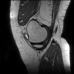 File:Acute-on-chronic transient lateral patellar dislocation with trochlear dysplasia (Radiopaedia 84099-99349 Sagittal PD 38).jpg