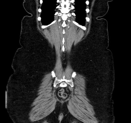 Acute appendicitis, heterotaxy syndrome (Radiopaedia 66884-76202 Coronal C+ portal venous phase 111).jpg