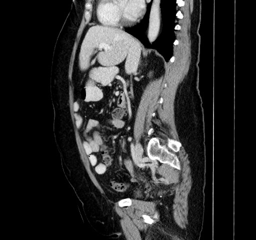 Acute appendicitis, heterotaxy syndrome (Radiopaedia 66884-76202 Sagittal C+ portal venous phase 81).jpg