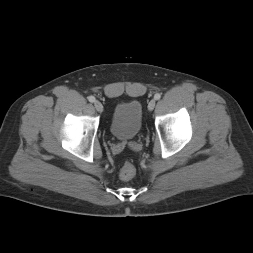 Acute appendicitis (Radiopaedia 48511-53463 Axial C+ portal venous phase 94).jpg