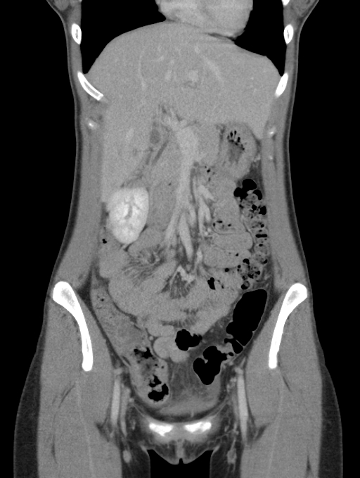 Acute appendicitis (Radiopaedia 62608-70901 Coronal C+ portal venous phase 13).jpg