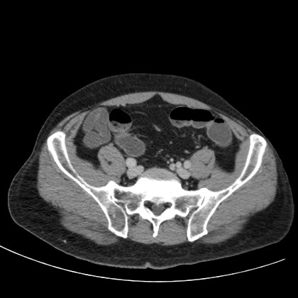 Acute appendicitis (Radiopaedia 66513-75790 Axial C+ portal venous phase 66).jpg