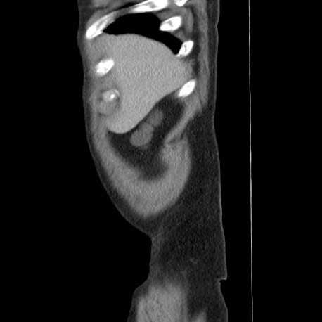 Acute appendicitis (Radiopaedia 66513-75790 Sagittal C+ portal venous phase 4).jpg