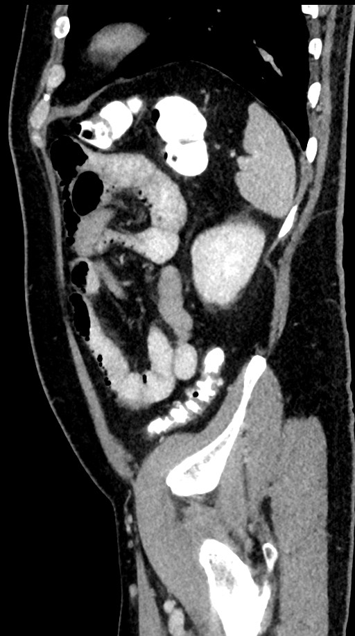 Acute appendicitis (Radiopaedia 77016-88960 Sagittal C+ portal venous phase 25).jpg