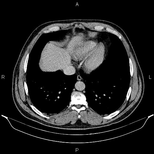 File:Acute appendicitis (Radiopaedia 84780-100240 Axial C+ portal venous phase 9).jpg