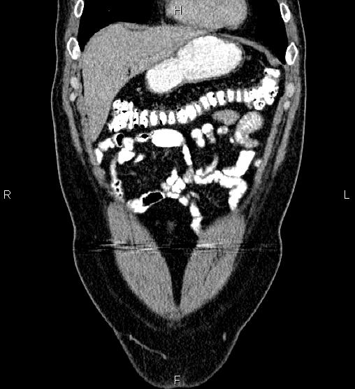 Acute appendicitis (Radiopaedia 84780-100240 Coronal C+ portal venous phase 14).jpg