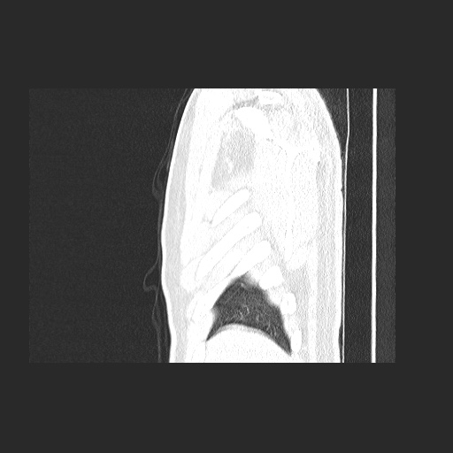 File:Acute appendicitis and COVID 19 pneumonia (Radiopaedia 76604-88380 Sagittal lung window 11).jpg