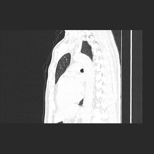 File:Acute appendicitis and COVID 19 pneumonia (Radiopaedia 76604-88380 Sagittal lung window 57).jpg