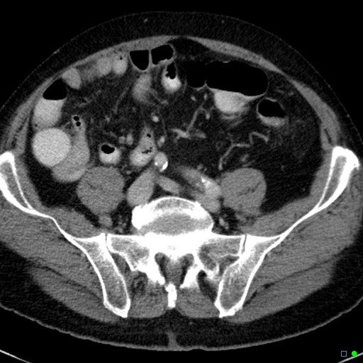File:Acute appendicitis arising from a malrotated cecum (Radiopaedia 19970-19997 Axial C+ portal venous phase 30).jpg