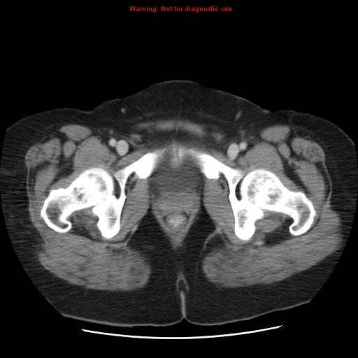 Acute appendicitis complicated by ovarian vein thrombophlebitis (Radiopaedia 16172-15851 Axial C+ portal venous phase 86).jpg