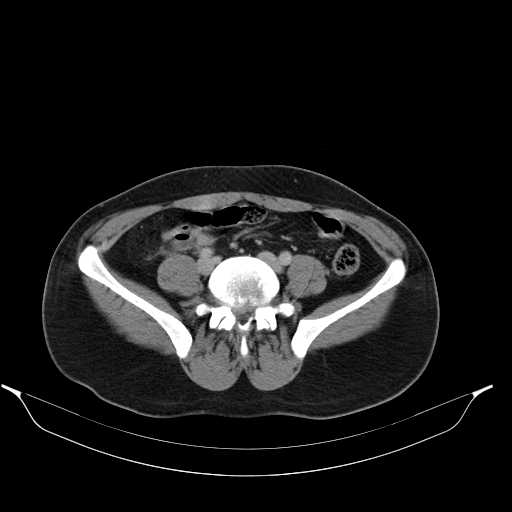 File:Acute appendicitis with appendicoliths (Radiopaedia 21148-21062 Axial C+ portal venous phase 11).jpg