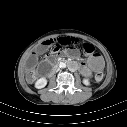 Acute bowel ischemia (Radiopaedia 87695-104114 Axial C+ portal venous phase 42).jpg