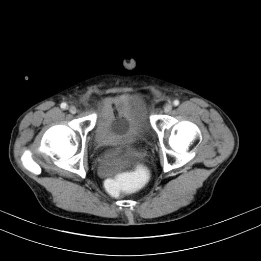 Acute bowel ischemia (Radiopaedia 87695-104114 Axial C+ portal venous phase 81).jpg