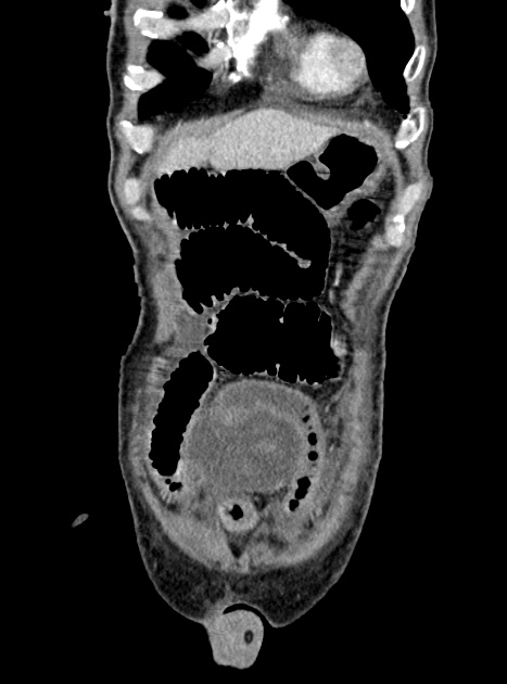 Acute bowel ischemia (Radiopaedia 87695-104114 Coronal C+ portal venous phase 97).jpg