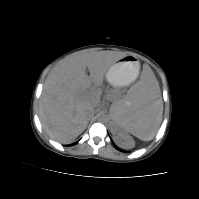 File:Acute calculous cholecystitis in patient with osteopetrosis (Radiopaedia 77871-90159 Axial non-contrast 26).jpg