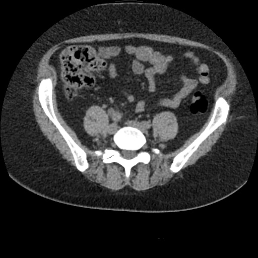 Acute cholecystitis and ureteric colic (Radiopaedia 42330-45444 Axial prone 71).jpg