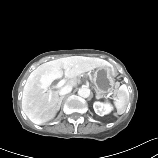 Acute cholecystitis with contained perforation (Radiopaedia 47328-51907 Axial C+ portal venous phase 20).png