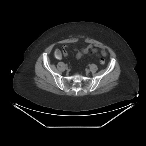 File:Acute cholecystitis with tensile fundus sign (Radiopaedia 71394-81723 Axial non-contrast 88).jpg