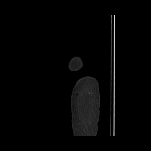 File:Acute cholecystitis with tensile fundus sign (Radiopaedia 71394-81723 Sagittal non-contrast 10).jpg