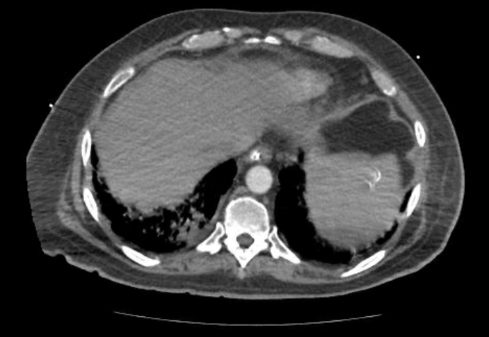 File:Acute cor pulmonale (ultrasound) (Radiopaedia 83508-98818 Axial C+ CTPA 67).jpg