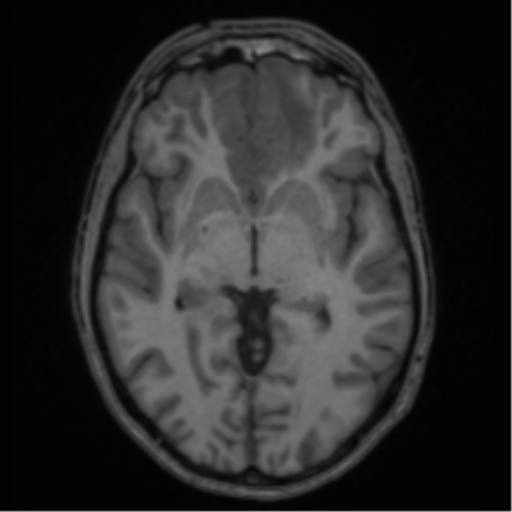 Acute disseminated encephalomyelitis (ADEM) (Radiopaedia 65319-74349 Axial T1 29).png