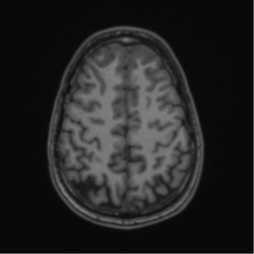 Acute disseminated encephalomyelitis (ADEM) (Radiopaedia 65319-74349 Axial T1 52).png