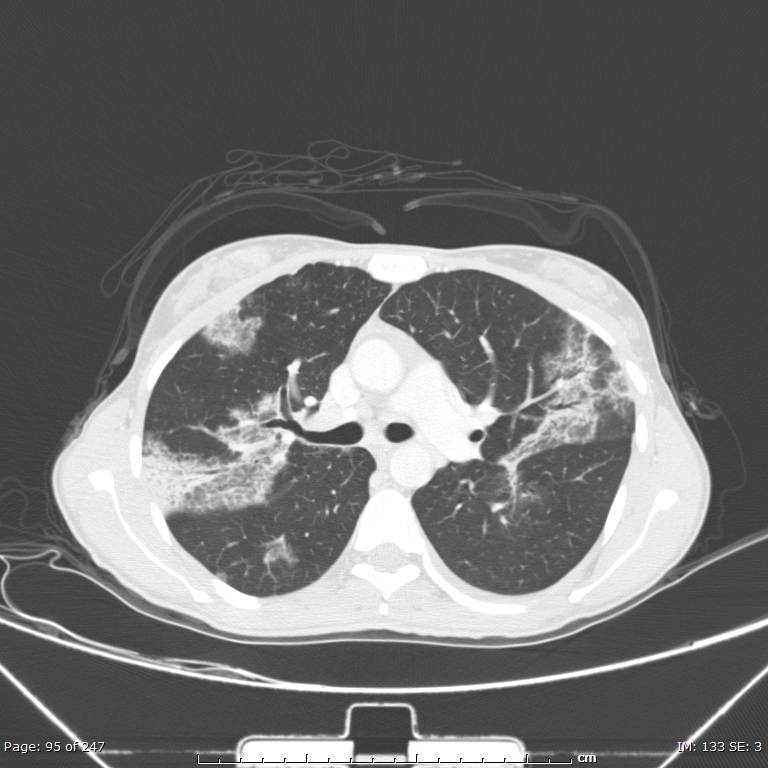 Acute eosinophilic pneumonia (Radiopaedia 48211-53073 Axial lung window 34).jpg