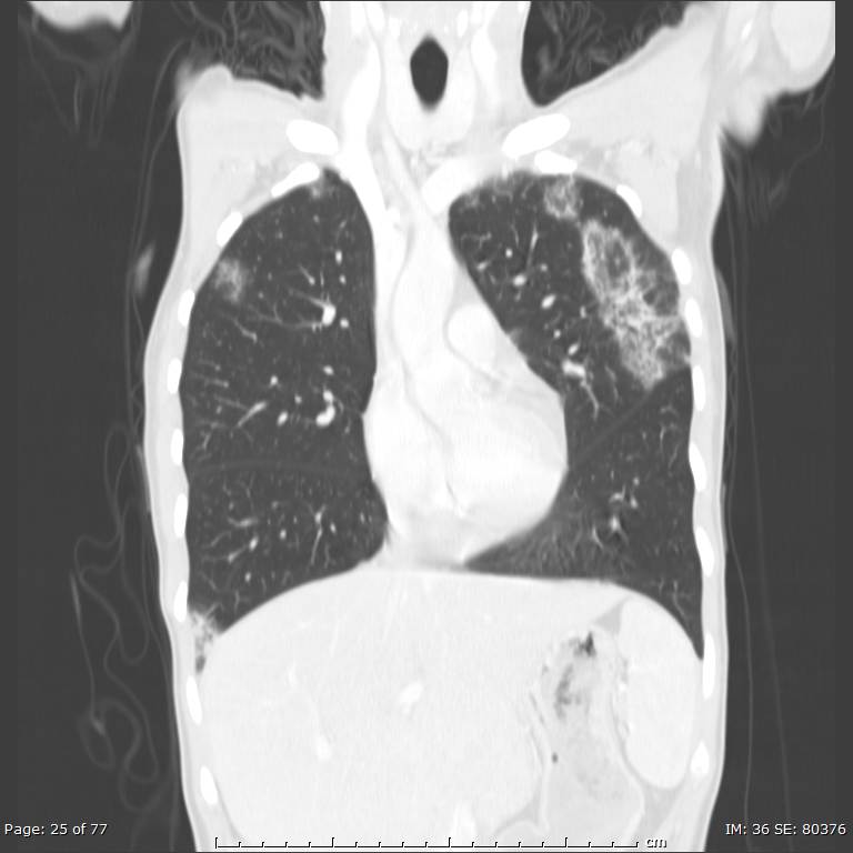 Acute eosinophilic pneumonia (Radiopaedia 48211-53073 Coronal lung window 16).jpg
