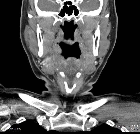 Acute epiglottitis (Radiopaedia 54375-60590 Coronal C+ arterial phase 32).jpg