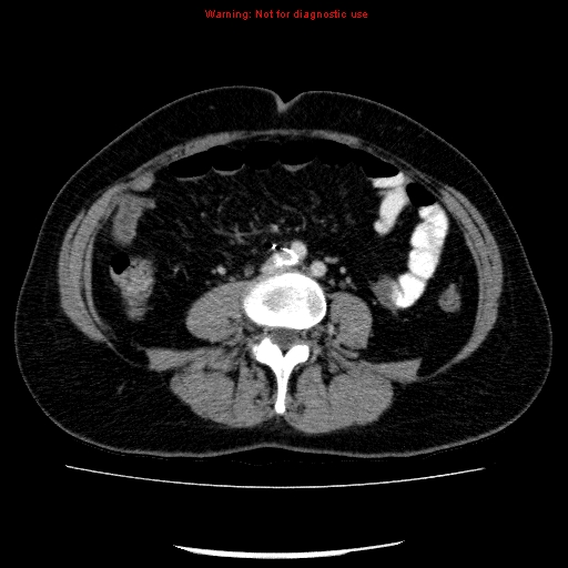 Acute gangrenous cholecystitis (Radiopaedia 10123-10661 Axial C+ portal venous phase 63).jpg
