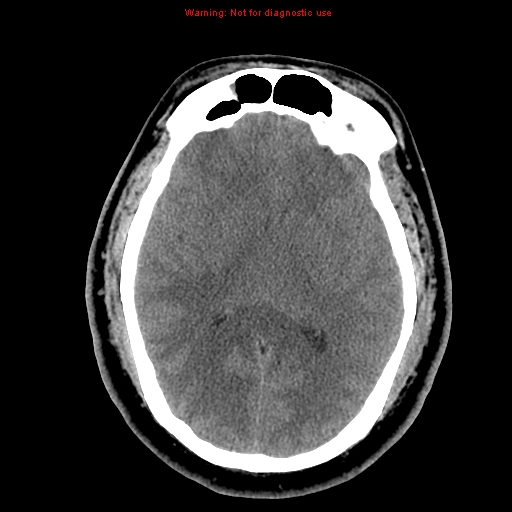 Acute hemorrhagic leukoencephalitis (Radiopaedia 14076-13920 Axial non-contrast 24).jpg