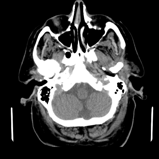 Acute hemorrhagic stroke (Radiopaedia 17507-17223 Axial non-contrast 9).jpg