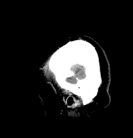 Acute internal carotid artery dissection (Radiopaedia 53541-59558 Sagittal non-contrast 59).jpg