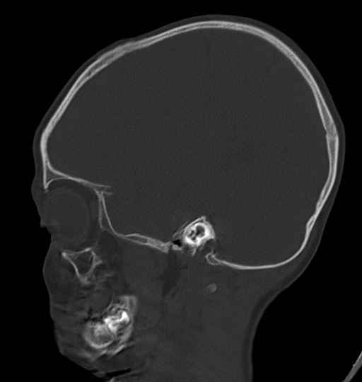 File:Acute mastoiditis (Radiopaedia 82678-96881 Sagittal bone window 19).jpg