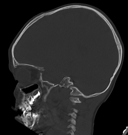 Acute mastoiditis (Radiopaedia 82678-96881 Sagittal bone window 23).jpg