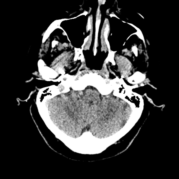 Acute middle cerebral artery territory infarct (Radiopaedia 52380-58283 Axial non-contrast 14).jpg