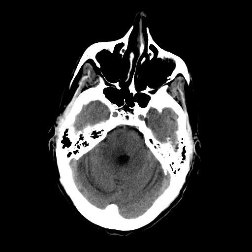 File:Acute necrotizing toxoplasma encephalitis (Radiopaedia 10683-11150 Axial non-contrast 25).jpg