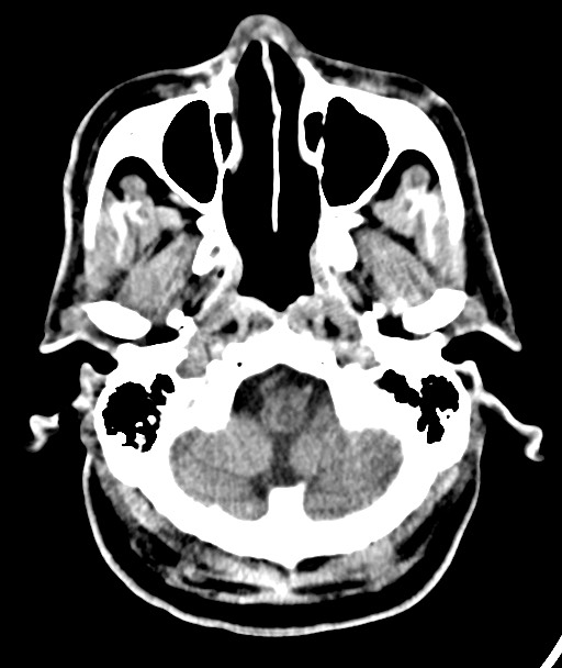Acute on chronic subdural hematoma (Radiopaedia 78346-90966 Axial non-contrast 15).jpg