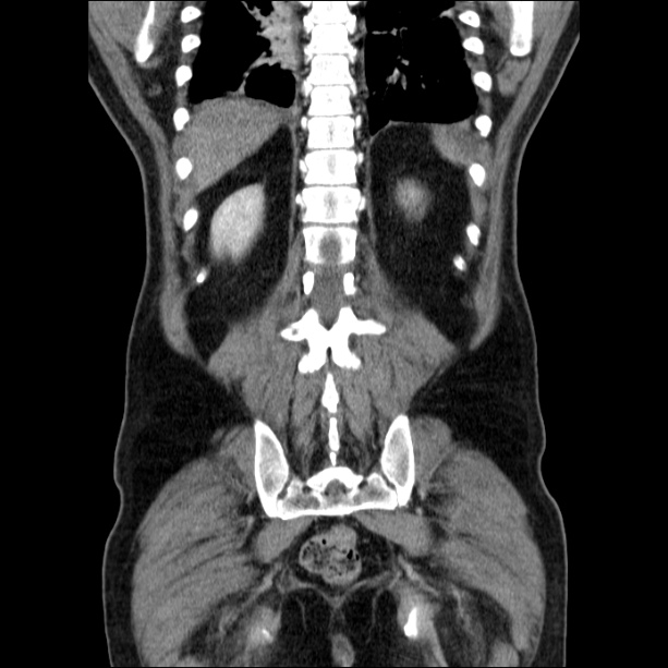 Acute pancreatitis (Radiopaedia 26663-26813 Coronal C+ portal venous phase 51).jpg