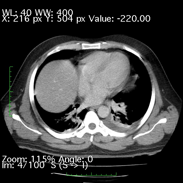 Acute pancreatitis (Radiopaedia 34043-35276 Axial C+ portal venous phase 4).jpg