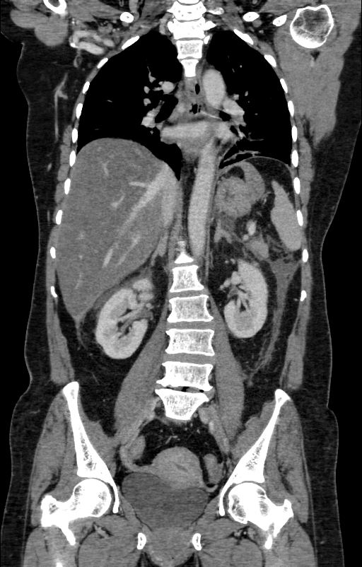 Acute pancreatitis (Radiopaedia 80007-93285 Coronal C+ portal venous phase 84).jpg