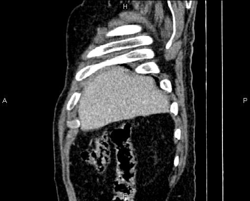 Acute pancreatitis (Radiopaedia 85146-100701 Sagittal C+ portal venous phase 10).jpg