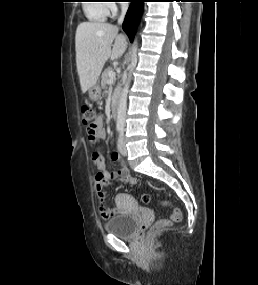 File:Acute pancreatitis - Balthazar E - post ERCP (Radiopaedia 27562-27772 Sagittal C+ portal venous phase 68).png
