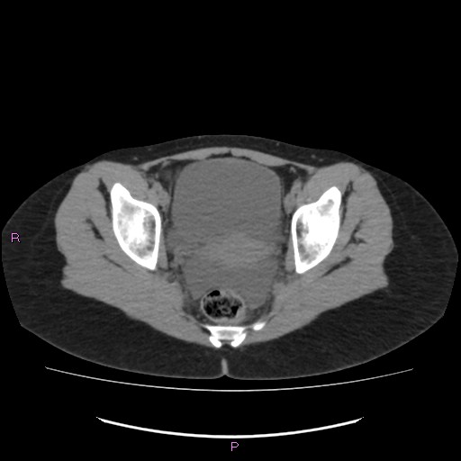 Acute pancreatitis secondary to stone at minor papilla and pancreatic divisum (Radiopaedia 76570-88333 Axial non-contrast 70).jpg