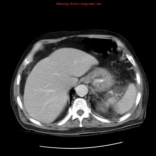 File:Acute pancreatitis with incidental pancreatic lipoma (Radiopaedia 10190-10730 Axial C+ portal venous phase 13).jpg