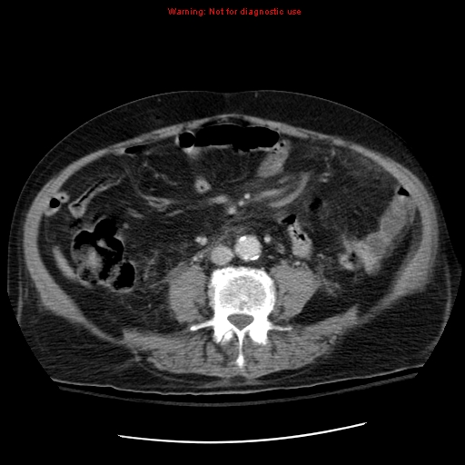 File:Acute pancreatitis with incidental pancreatic lipoma (Radiopaedia 10190-10730 Axial C+ portal venous phase 45).jpg