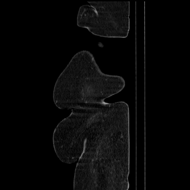 Acute pyelonephritis (Radiopaedia 25657-25837 Sagittal renal parenchymal phase 77).jpg