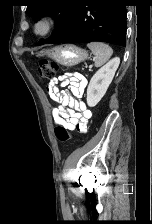 Acute renal infarction - rim capsular enhancement (Radiopaedia 59833-67270 Sagittal C+ portal venous phase 24).jpg