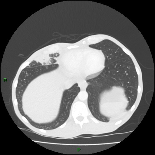 Acute right lung abscess (Radiopaedia 34806-36258 Axial lung window 153).jpg